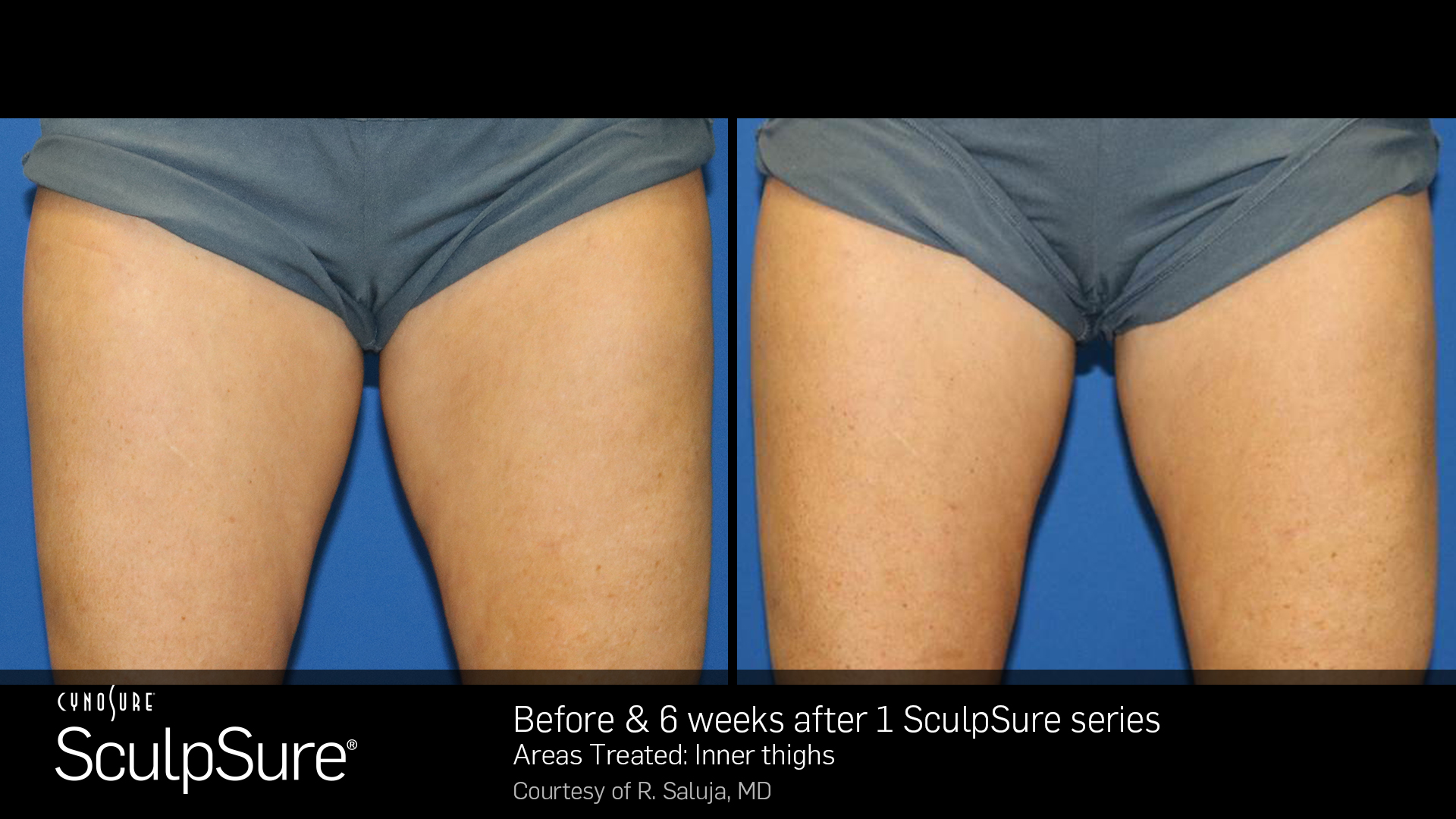 marketing_materials_BA_SculpSure_R.Saluja_InnerThigh_1tx_6weeks.jpg