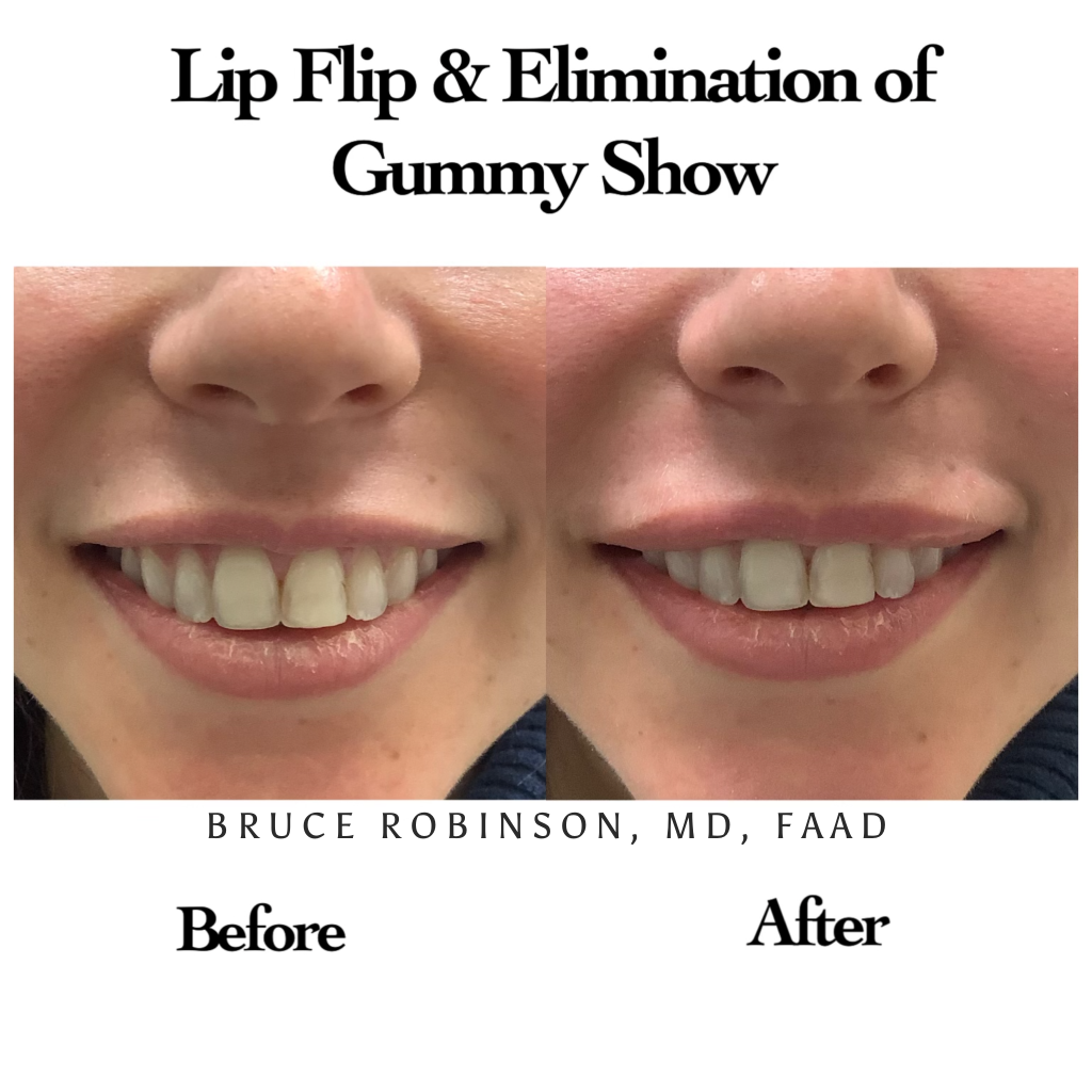 lip flip washington d.c. Lip Augmentation Washington, DC, & Arlington, VA Juvly Aesthetics: Botox Lip Flip